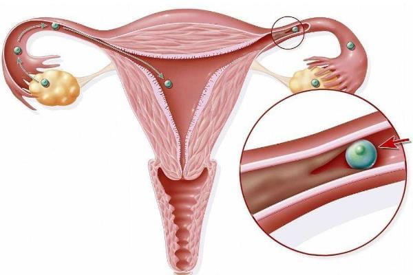 女性输卵管堵塞还能做试管婴儿吗？女性输卵管堵塞有什么自查方法吗？国内外做试管婴儿有哪些条件？插图