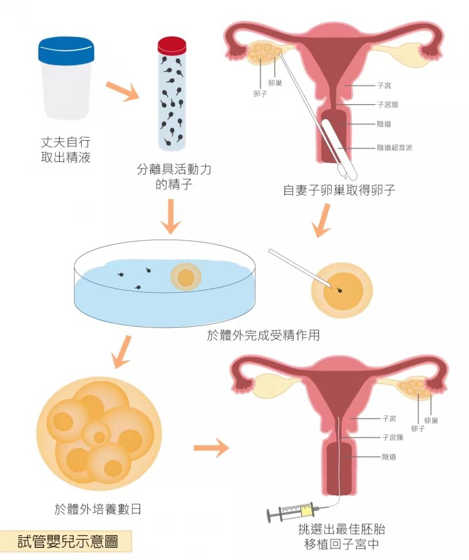 做试管婴儿的流程是怎么样的，三代试管婴儿有什么区别，试管婴儿促排流程及注意事项插图(1)