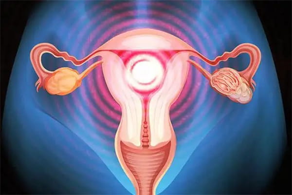 多囊卵巢综合征有哪些明显的症状？为什么多囊卵巢综合征会导致不易怀孕？多囊卵巢综合征患者进行试管婴儿技术？插图(1)