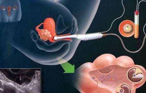 试管婴儿为什么有的人取卵比较少？基础卵泡少能否进行试管婴儿？插图