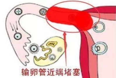 做试管婴儿前查出宫腔粘连需要治疗吗？面对不同情况的宫腔粘连，试管婴儿的成功率也不同！插图