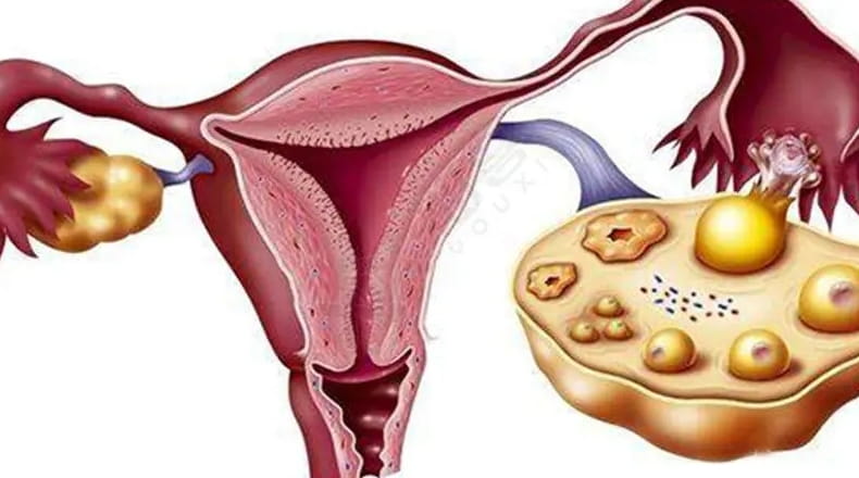 多囊怀孕的几率有多大？查出多囊还能做试管婴儿怀孕吗？多囊怀孕以后需要注意什么？插图(1)