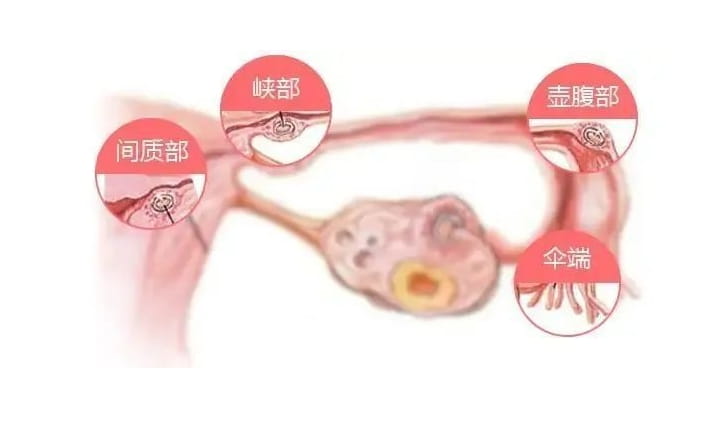 输卵管性不孕怎么治疗？引起输卵管性不孕的原因有哪些？输卵管性不孕能做试管婴儿吗?插图