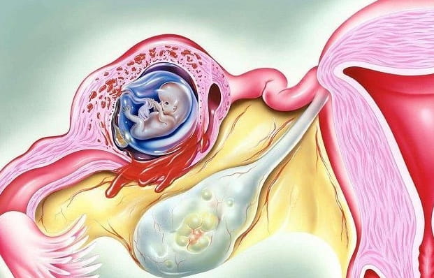 宫外孕是什么？哪些姐妹易发生宫外孕呢？手术后是先造影还是先备孕？插图(2)