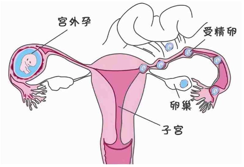 宫外孕是什么？哪些姐妹易发生宫外孕呢？手术后是先造影还是先备孕？插图(1)