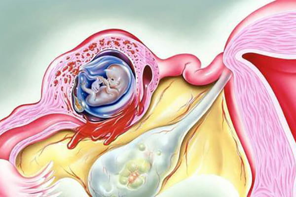 试管婴儿：科学之光下的孕育之旅，输卵管妊娠的疑虑如何解答？插图(1)