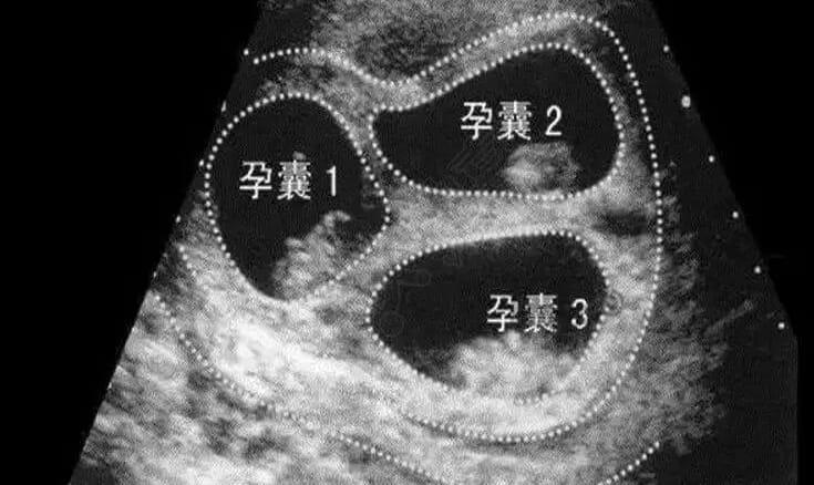 医学上多胎妊娠是指什么？试管婴儿生多胞胎没有风险？生多胞胎对产妇有什么影响？插图